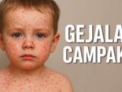 17 Anak Meninggal akibat Wabah Campak di Sumenep, Pemkab Tetapkan KLB